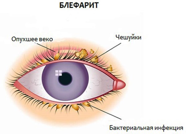 Капли для глаз увлажняющие при ношении линз, работе за компьютером, без консервантов, с гиалуроновой кислотой, от покраснения, усталости, сухости. Список