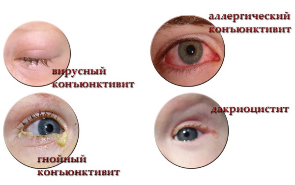 Капли от конъюнктивита для детей от года, 2-5 лет, с антибиотиком. Список лучших: Левомицетин, Тобрекс