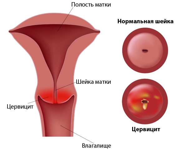 Коккобациллы в мазке что это значит 30