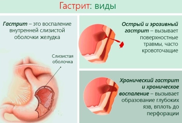 Кора крушины: лечебные свойства, польза для похудения, от запора, для здоровья женщин. Рецепты, как готовить отвар и принимать, противопоказания