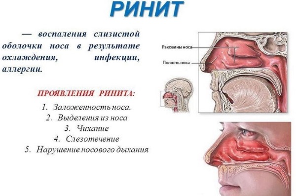 Кровь из носа у ребенка. Причины, виды кровотечения, что делать, как остановить. Первая помощь, лекарства