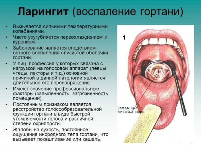 Ларингит. Симптомы и лечение у взрослых в домашних условиях: острый, хронический, аллергический. Ингаляции, антибиотики, таблетки