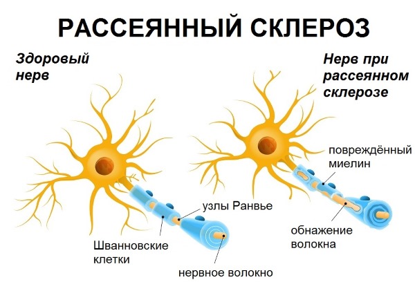 Онемение пальцев и стоп ног, потеря равновесия. Причины при диабете, после химиотерапии, лазера. Лечение, народные средства