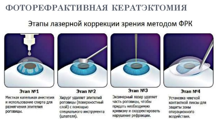 Операция на глаза: лазером по замене хрусталика, отслоении сетчатки, катаракта, глаукома, для улучшения зрения. Стоимость, послеоперационный период, последствия