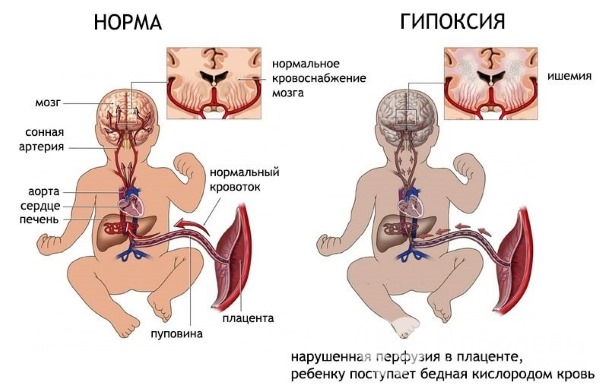 Отслойка плаценты на ранних и поздних сроках беременности. Симптомы, причины и последствия. Чем опасна, как происходит, лечение