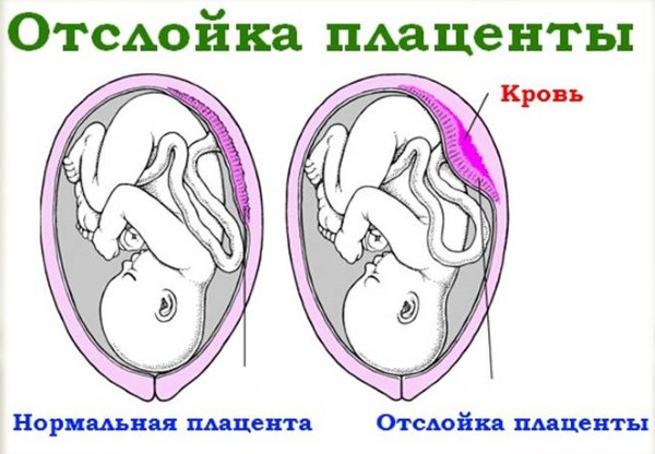 Отслойка плаценты на ранних и поздних сроках беременности. Симптомы, причины и последствия. Чем опасна, как происходит, лечение