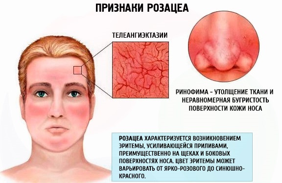 Розацеа на лице: фото, лечение народными средствами, препараты, диета, как вылечить лазером. Уход за кожей, косметика