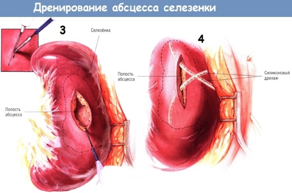 Селезенка: где находится и как болит. Симптомы и причины болей, первая помощь, особенности лечения