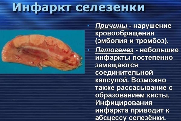 Селезенка: где находится и как болит. Симптомы и причины болей, первая помощь, особенности лечения