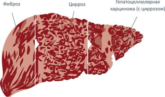 Софосбувир и Даклатасвир. Инструкция по применению, где купить. Схема лечения, какой производитель лучше