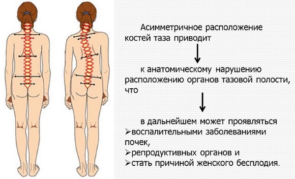 Упражнения для осанки. Правильная гимнастика для детей, взрослых, виды спорта. Как исправить осанку, выпрямить спину в домашних условиях