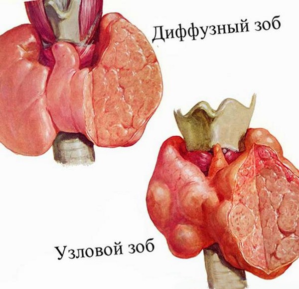 Увеличение щитовидной железы как выглядит фото