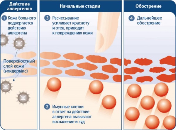 Дермазин крем. Инструкция по применению мази от ожогов, прыщей. Как действует, как пользоваться, как долго применять. Аналоги