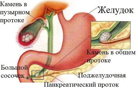 Диета При Желчекаменной Болезни После Операции