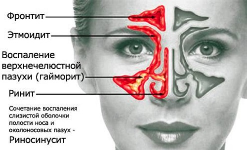 Этмоидит: симптомы и лечение. Хронический, острый, полипозный, катаральный, двусторонний. Как лечить заболевание головного мозга