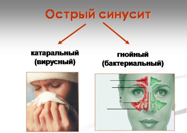 Этмоидит: симптомы и лечение. Хронический, острый, полипозный, катаральный, двусторонний. Как лечить заболевание головного мозга