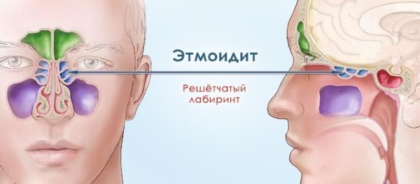 Этмоидит: симптомы и лечение. Хронический, острый, полипозный, катаральный, двусторонний. Как лечить заболевание головного мозга