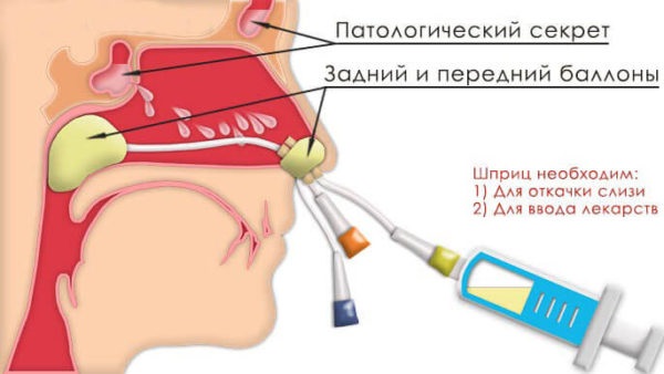 Этмоидит: симптомы и лечение. Хронический, острый, полипозный, катаральный, двусторонний. Как лечить заболевание головного мозга