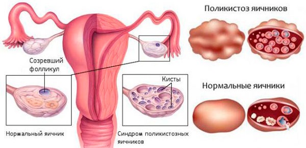 Фолликулометрия: что это такое, как проводится УЗИ малого таза, нормы, подготовка, что показывает, цена