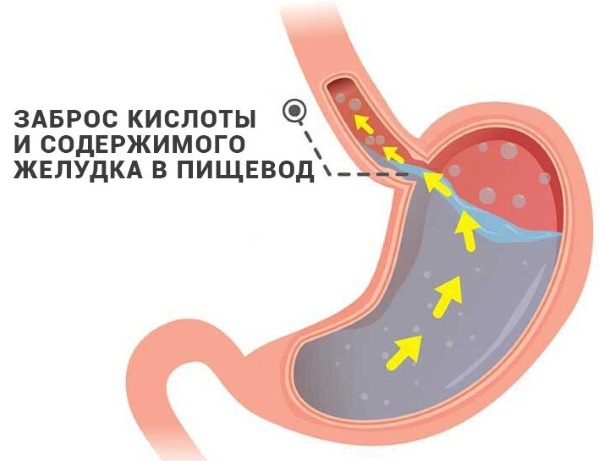 Причины и лечение горечи во рту по утрам, после еды, ночью, после антибиотиков. Как убрать привкус: таблетки, диета