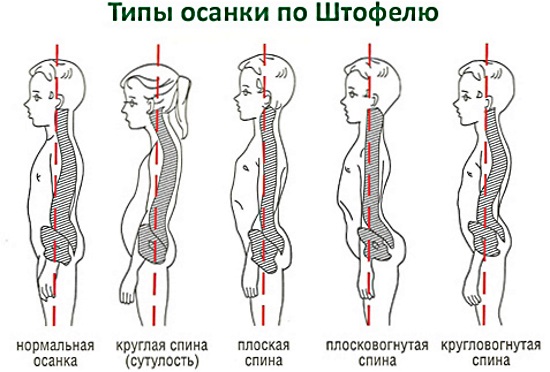 Спондилез грудного отдела позвоночника. Что это такое, симптомы, лечение