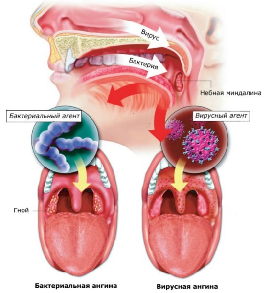 Лечение фолликулярной ангины у взрослых с температурой и без, кашлем. Антибиотики, препараты, народные средства