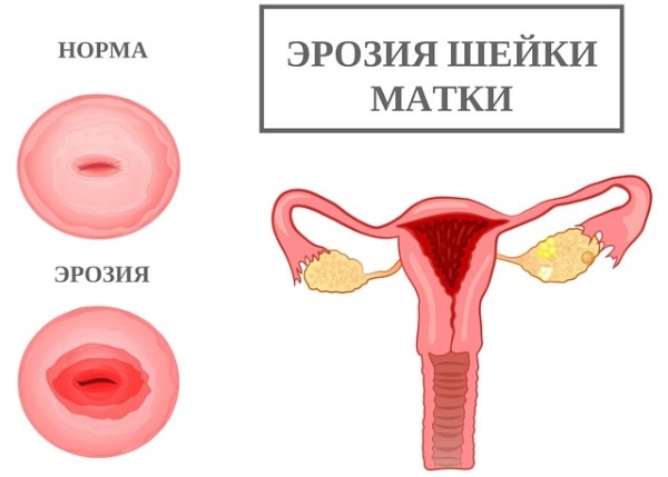 Мажущие выделения в середине цикла без боли. Причины у женщин при приеме противозачаточных