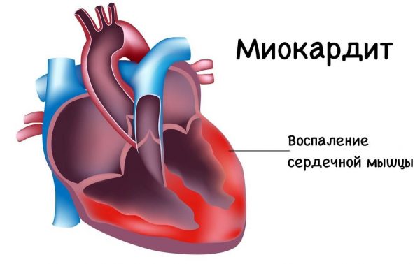 Воспаление сердечной мышцы. Что это такое, симптомы, лечение у взрослых