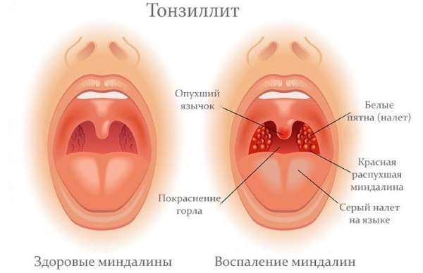 Народные средства от боли в горле взрослым, для детей, женщинам при беременности