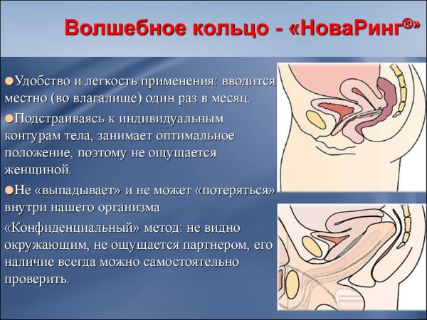 Кольцо Нова Ринг. Противозачаточный контрацептив. Инструкция по применению, цена, отзывы, побочные эффекты