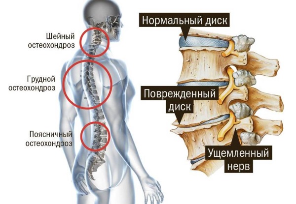 Шейный остеохондроз. Симптомы и лечение в домашних условиях. Упражнения, гимнастика, массаж, уколы, таблетки, мази