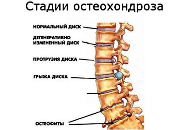 Шейный остеохондроз. Симптомы и лечение в домашних условиях. Упражнения, гимнастика, массаж, уколы, таблетки, мази