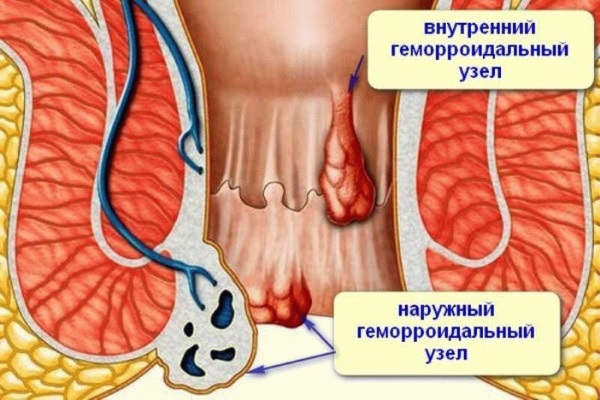 Сургитрон - что это такое, суть методики, применение аппарата в косметологии, гинекологии, лечение эрозия шейки матки, геморроя, удаление родинок