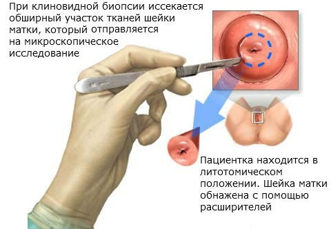 Сургитрон - что это такое, суть методики, применение аппарата в косметологии, гинекологии, лечение эрозия шейки матки, геморроя, удаление родинок