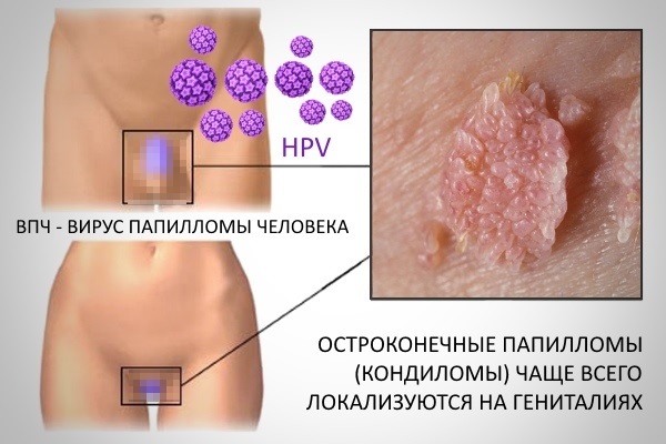 Сургитрон - что это такое, суть методики, применение аппарата в косметологии, гинекологии, лечение эрозия шейки матки, геморроя, удаление родинок