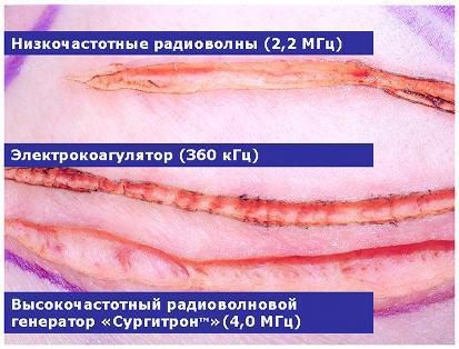 Сургитрон - что это такое, суть методики, применение аппарата в косметологии, гинекологии, лечение эрозия шейки матки, геморроя, удаление родинок