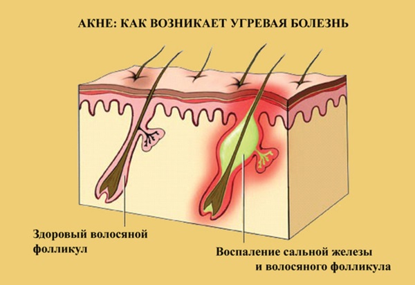 Циновит крем. Инструкция по применению от угрей, прыщей и черных точек, аллергических проявлений. Цена, отзывы, аналоги