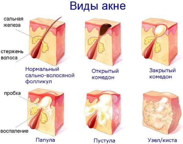 Циновит крем. Инструкция по применению от угрей, прыщей и черных точек, аллергических проявлений. Цена, отзывы, аналоги