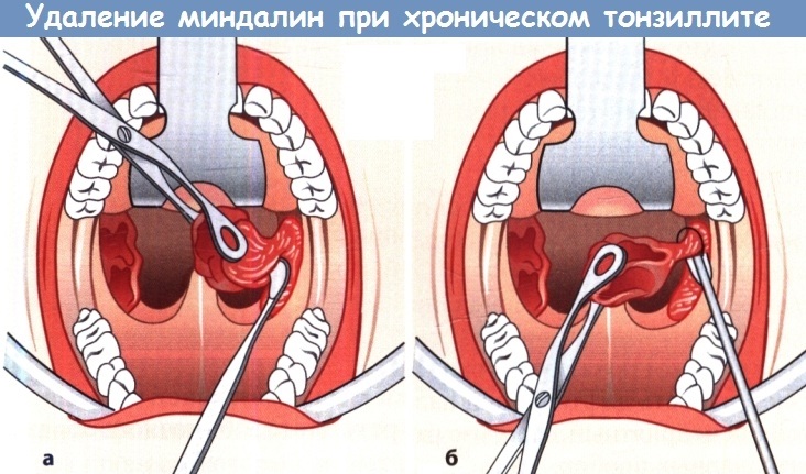 Лечение фолликулярной ангины у взрослых с температурой и без, кашлем. Антибиотики, препараты, народные средства