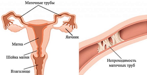 Уреаплазма у женщин. Причины, симптомы и лечение при беременности. Норма в анализах мазка, крови. Препараты