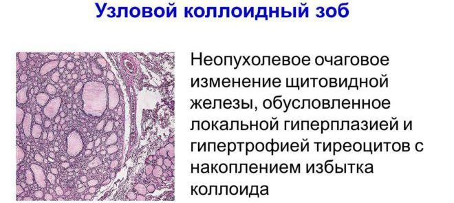 Зоб щитовидной железы. Что это такое, причины, симптомы и лечение. Народные средства, препараты, диета