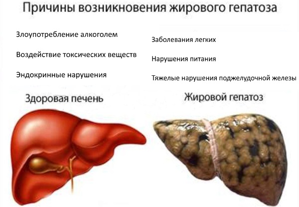 Жировой гепатоз печени. Симптомы и лечение медикаментозное, народными средствами, диета