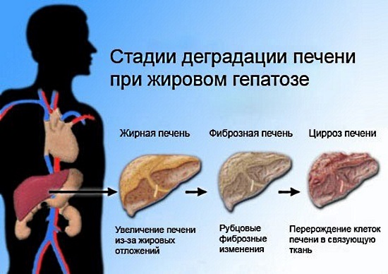 Жировой гепатоз печени. Симптомы и лечение медикаментозное, народными средствами, диета