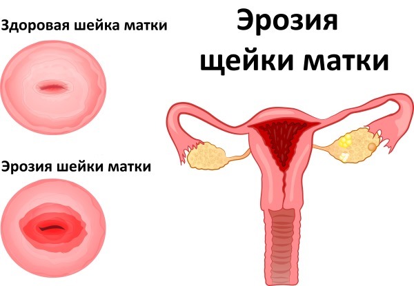 Анализ на цитологию в гинекологии. Что это значит, какие заболевания показывает. Чем отличается от мазка на онкомаркер, сколько делается. Расшифровка