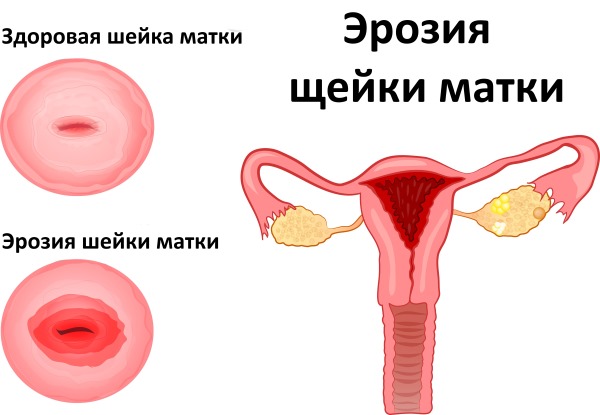 Барсучий жир. Полезные свойства, от чего помогает, как принимать в чистом виде, капсулах