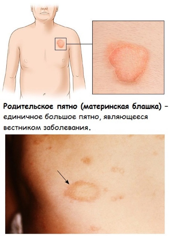 Белые пятна на теле. Причины и лечение, как избавиться народными средствами