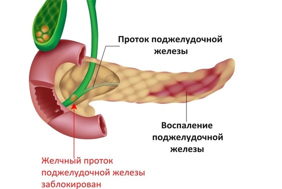 Болезни поджелудочной железы. Симптомы, признаки, причины и лечение. Таблетки, питание, диета, упражнения