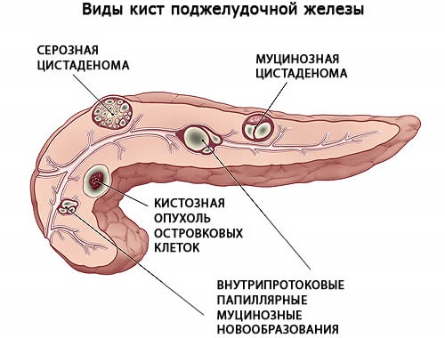 Болезни поджелудочной железы. Симптомы, признаки, причины и лечение. Таблетки, питание, диета, упражнения