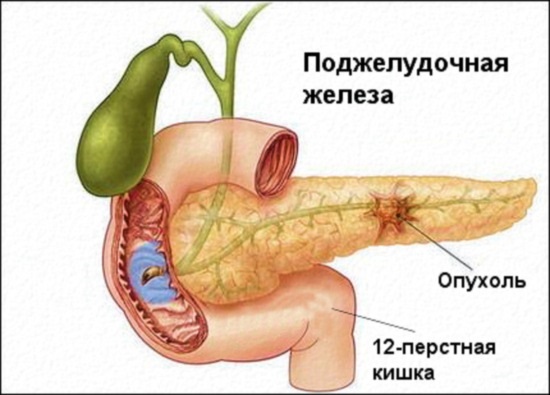 Болезни поджелудочной железы. Симптомы, признаки, причины и лечение. Таблетки, питание, диета, упражнения