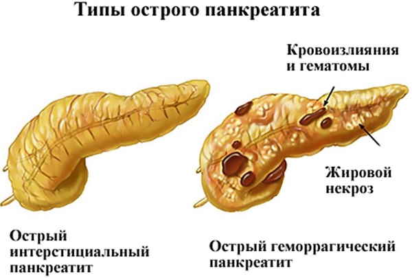 Болезни поджелудочной железы. Симптомы, признаки, причины и лечение. Таблетки, питание, диета, упражнения